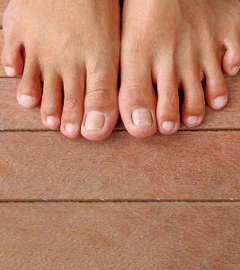 10 Remedies To Get Rid Of Ingrown Toenail...