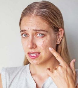 5 Best Home Remedies For Cystic Acne | Causes And Prevention