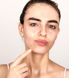 Hormonal Acne: Causes, How To Treat It, And Foods To Avoid