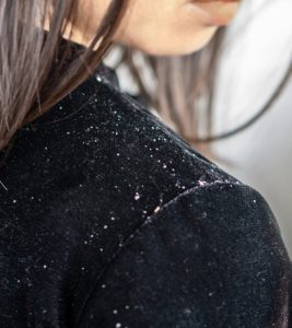 How To Get Rid Of Dandruff Naturally – 18 Tips And Remedies