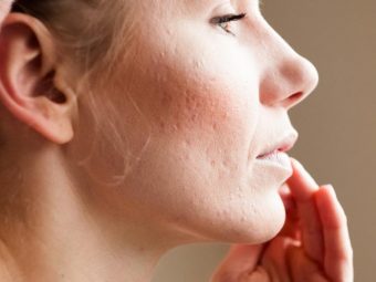 How To Get Rid Of Pitted Acne Scars Effectively