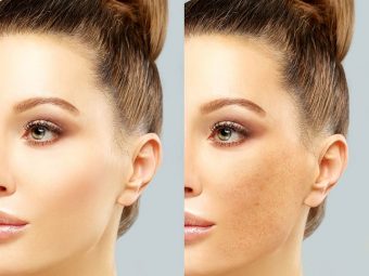 How To Prevent Pigmentation (Melasma) During Pregnancy