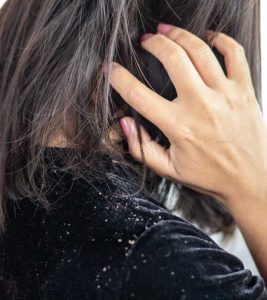 6 Best Hair Oils For Dandruff – Control...